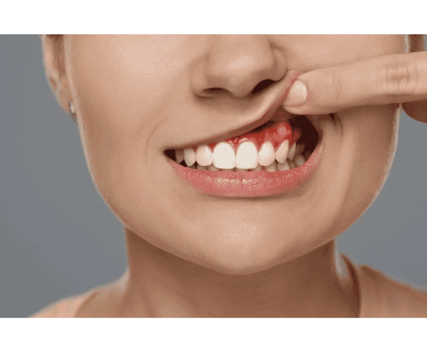 What is Gum Disease and How to Treat It?
