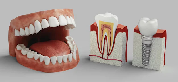 Dental Implants vs. Dentures: Which Is Right for You?