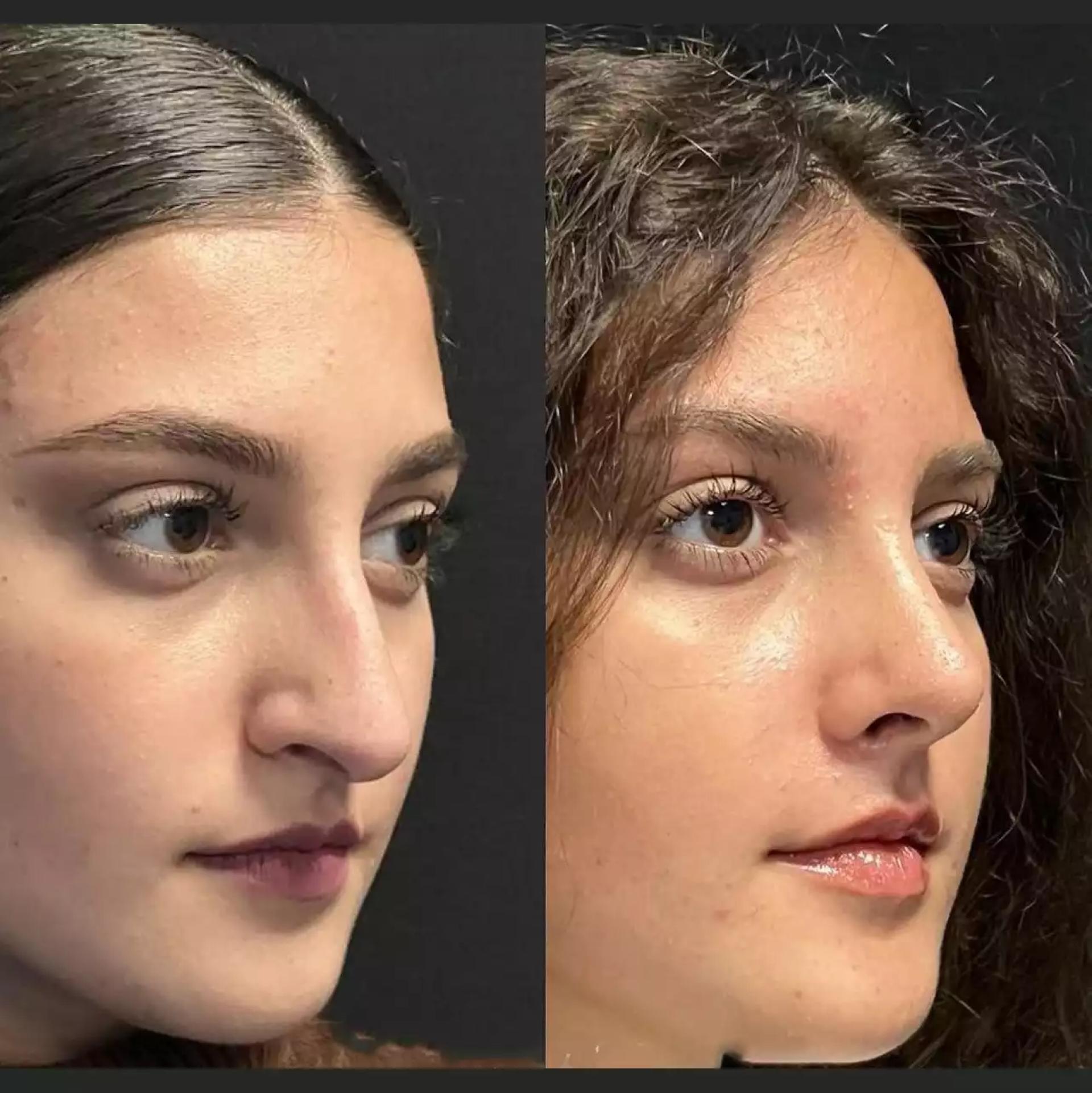 Before and After: Results from the Best Rhinoplasty Surgeons in Dubai