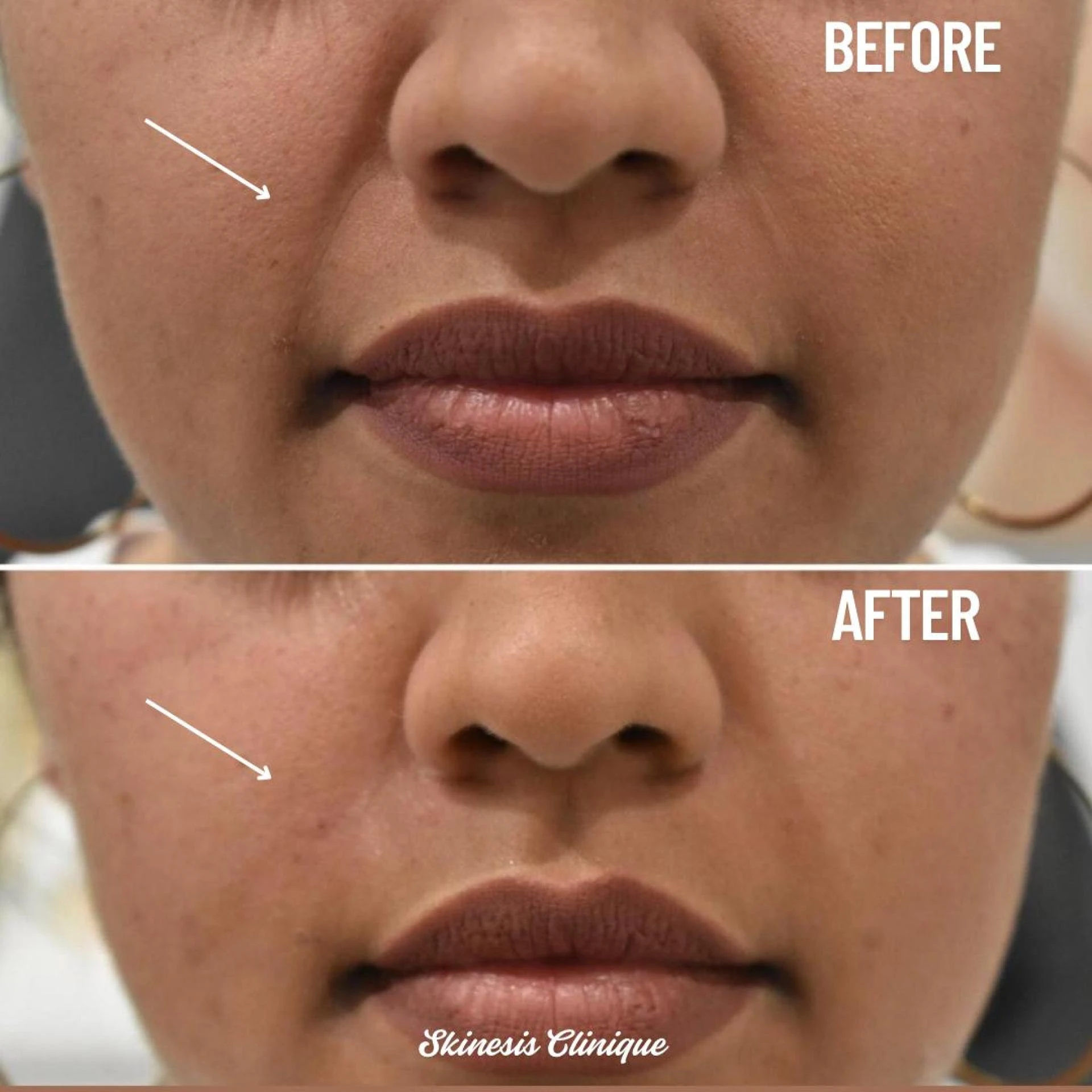 Dermal fillers (HA) for Laughing line (Nasolabial folds)
