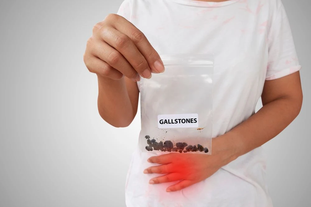 Gallstones: Causes, Symptoms, Diagnosis, and Treatment