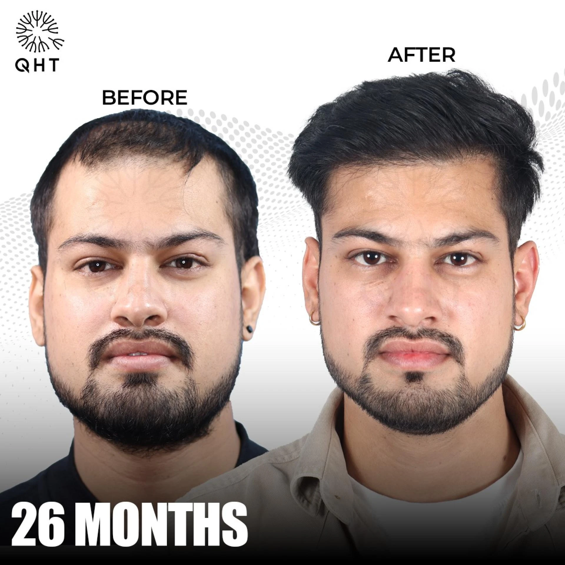 Understanding FUE Hair transplant Cost