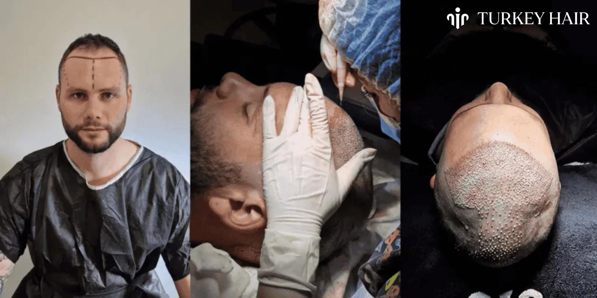 Why DHI Hair Transplant in Turkey Is the Ultimate Solution for Hair Loss