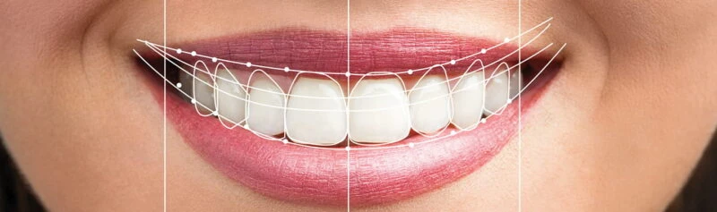 What is a Smile Makeover? Transform Your Smile, Transform Your Life
