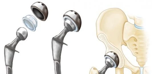 Exploring the Latest Technologies in Hip Replacement Surgery in Islamabad