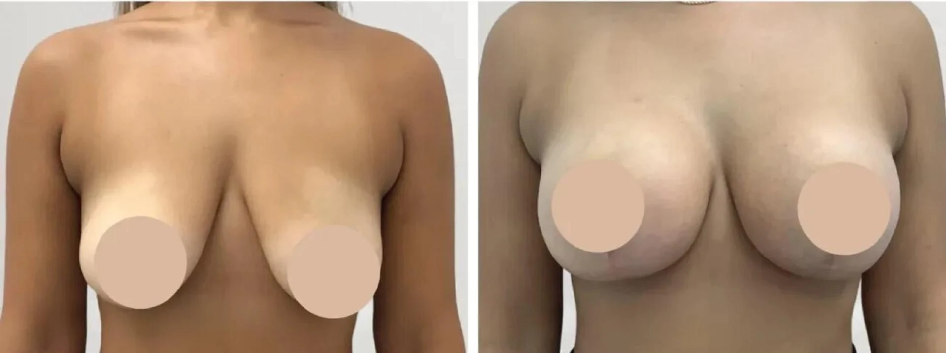 The Role of Expertise in Achieving Natural Results: How Best Breast Reduction Surgeon in dubai Deliver