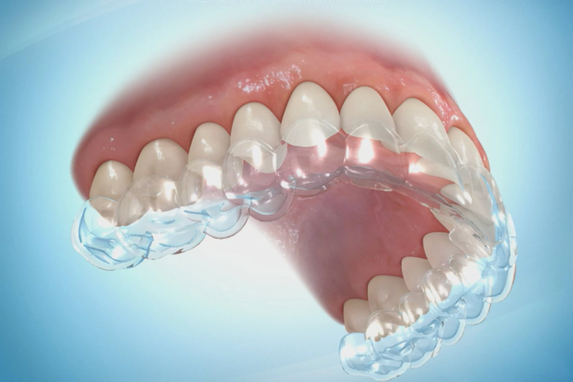 What to Expect During Your Invisalign Journey: A Week-by-Week Guide