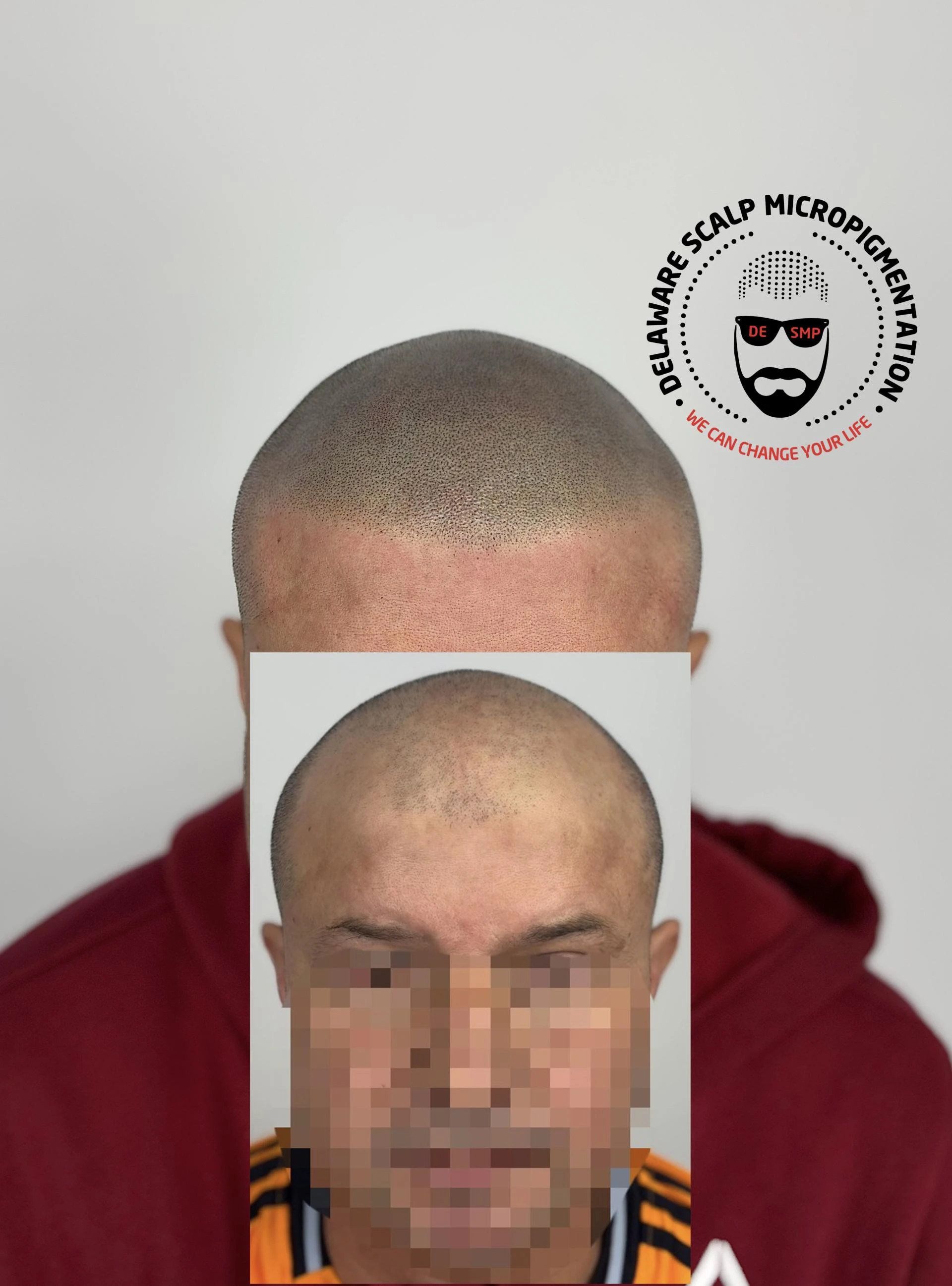 Everything You Need to Know About Tattooed Hairline Treatments