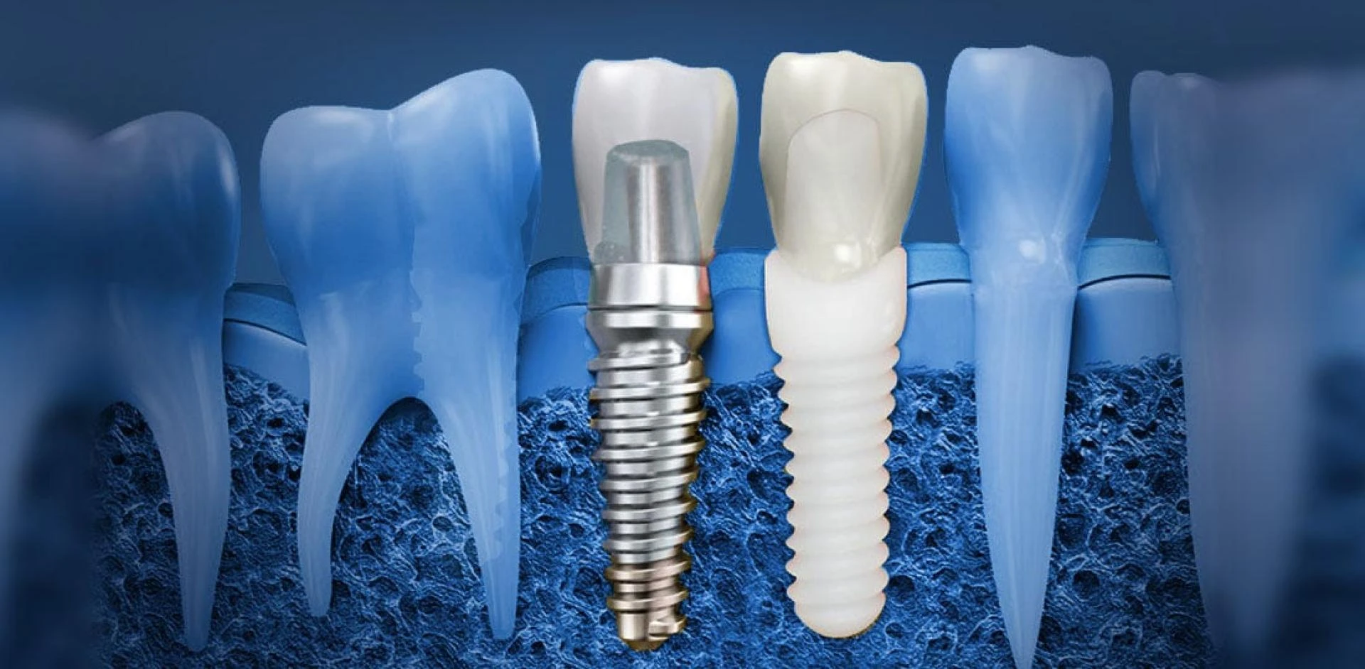 What Don’t They Tell You About Dental Implants?