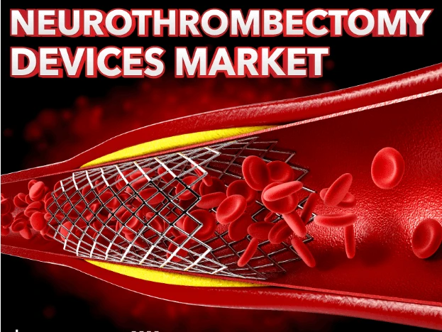 Neurothrombectomy Devices Market Growth Trajectories & Trends Across Industries 2032
