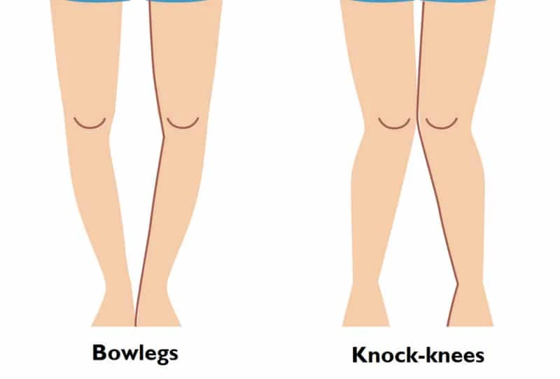 Bowlegged Babies: Normal Development or Reason to Worry?