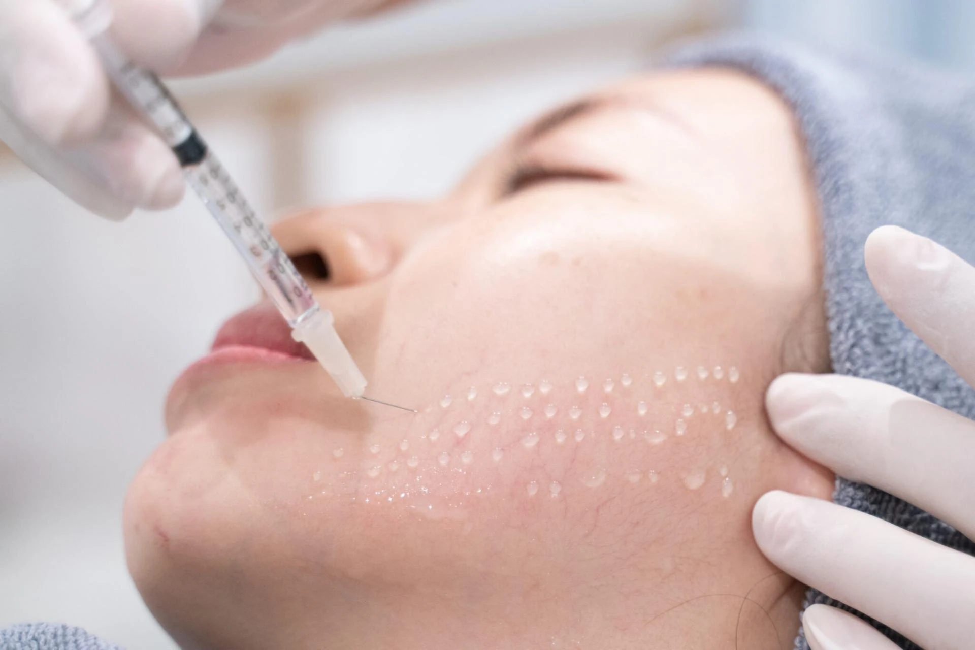 What serum is used for mesotherapy?