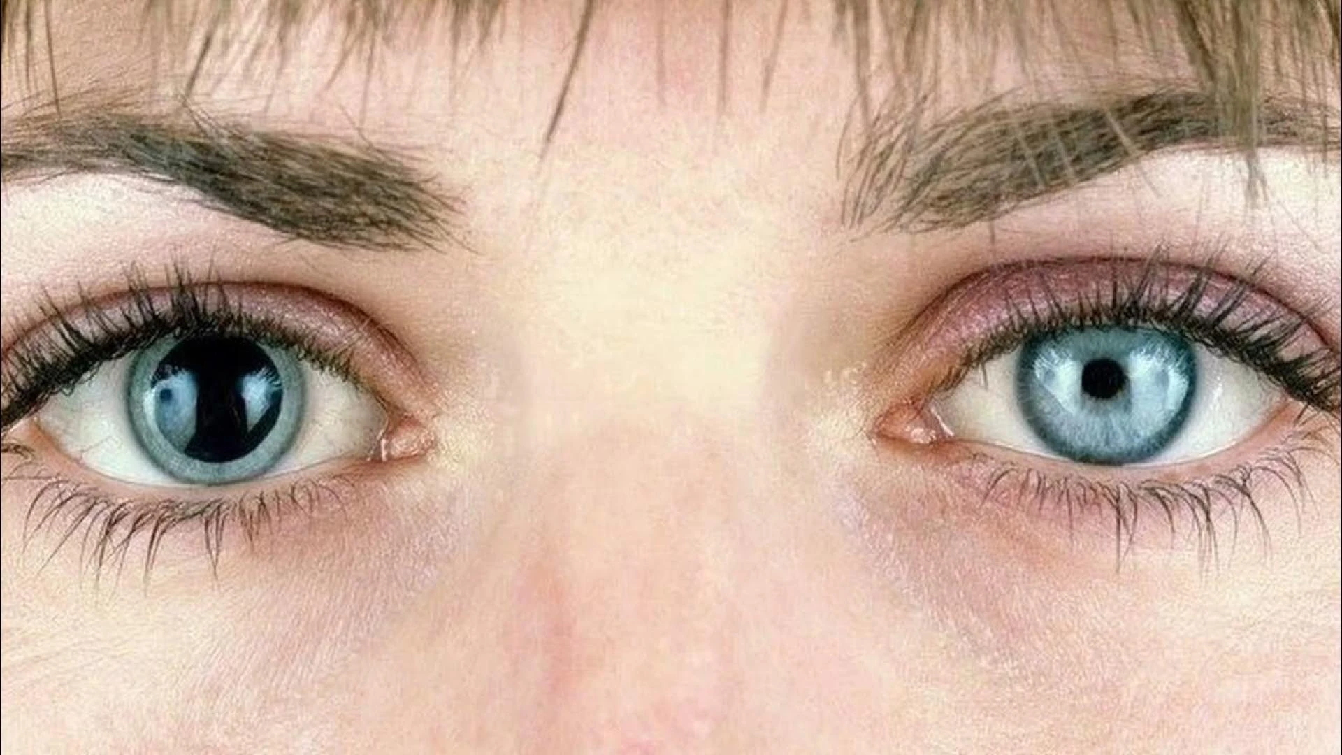 Small Pupils: What They Say About Your Health