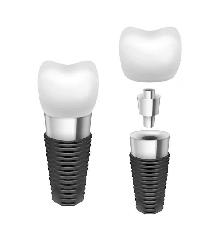 What to Expect When Getting a Single Dental Implant