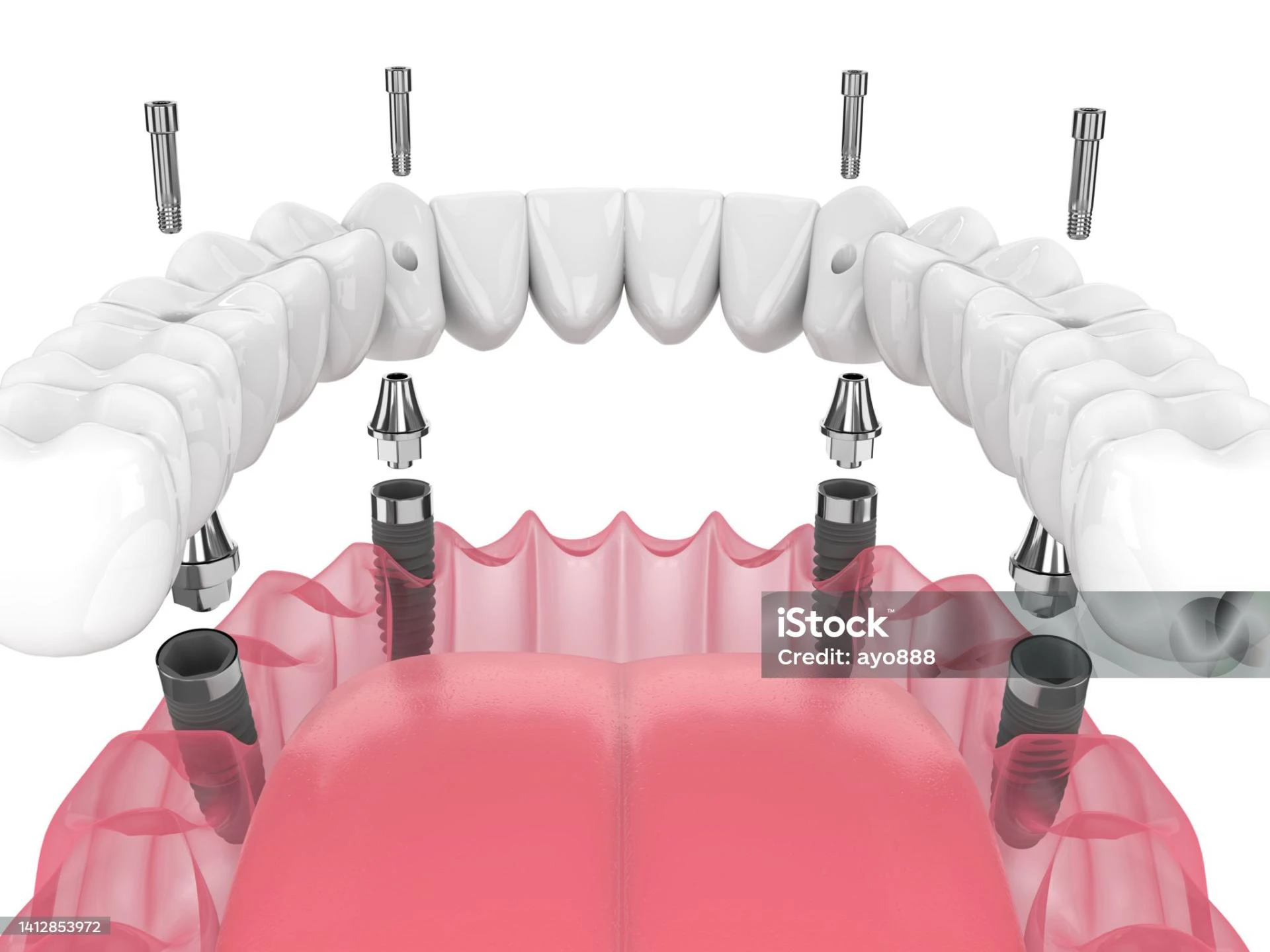 Dental Implants Clinic In Dubai