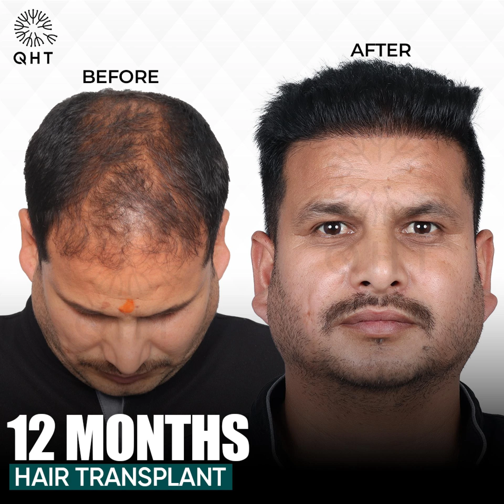 Best Hair Transplant at the Best Price – Book Your Consultation Now