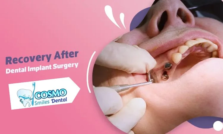 Recovery Tips from Arlington Dentists After Dental Implant Surgery