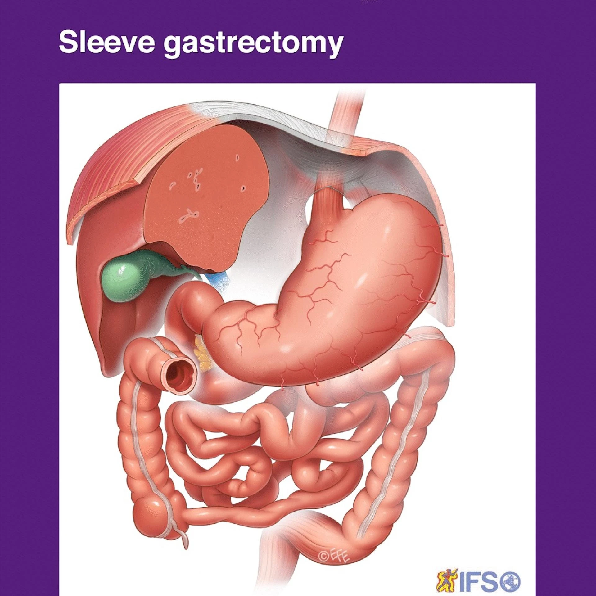 Top 5 Benefits of Choosing Sleeve Surgery in Sydney for Long-Term Weight Loss