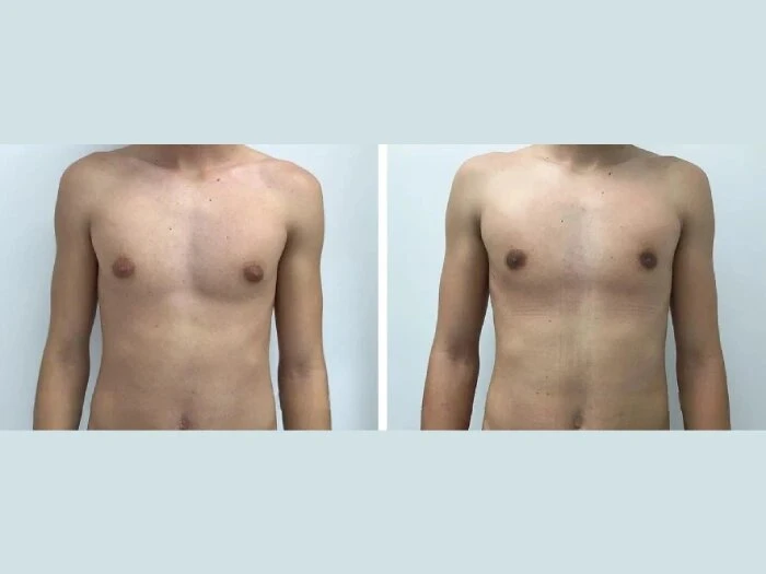 What Makes the Best Gynecomastia Surgeon in dubai the Right Choice for Your Surgery?