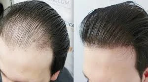 Hair Transplant Cost in Dubai: A Complete 2025 Price Guide