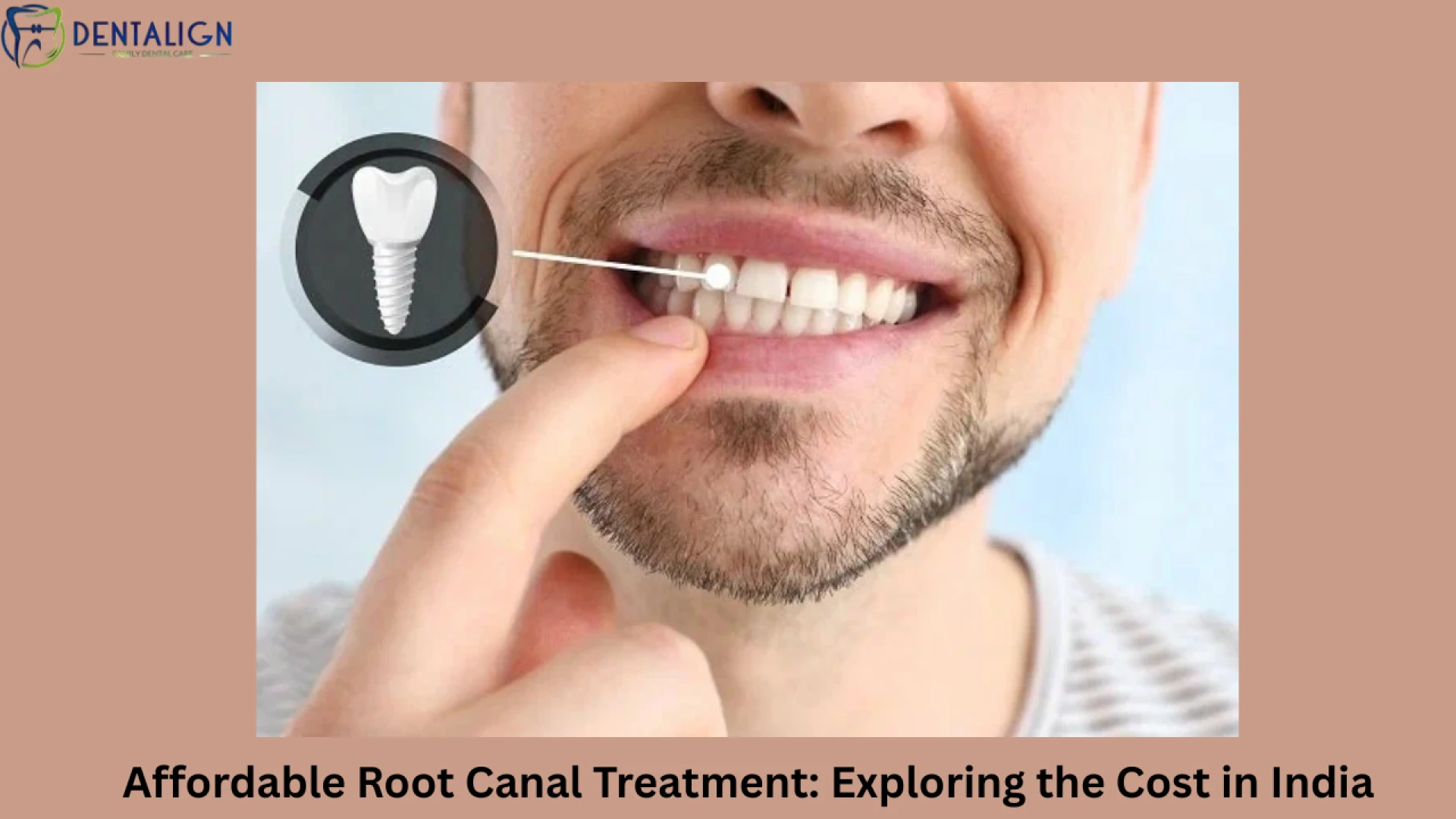 Affordable Root Canal Treatment: Exploring the Cost in India