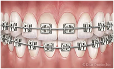 5 Benefits of Early Orthodontic Treatment