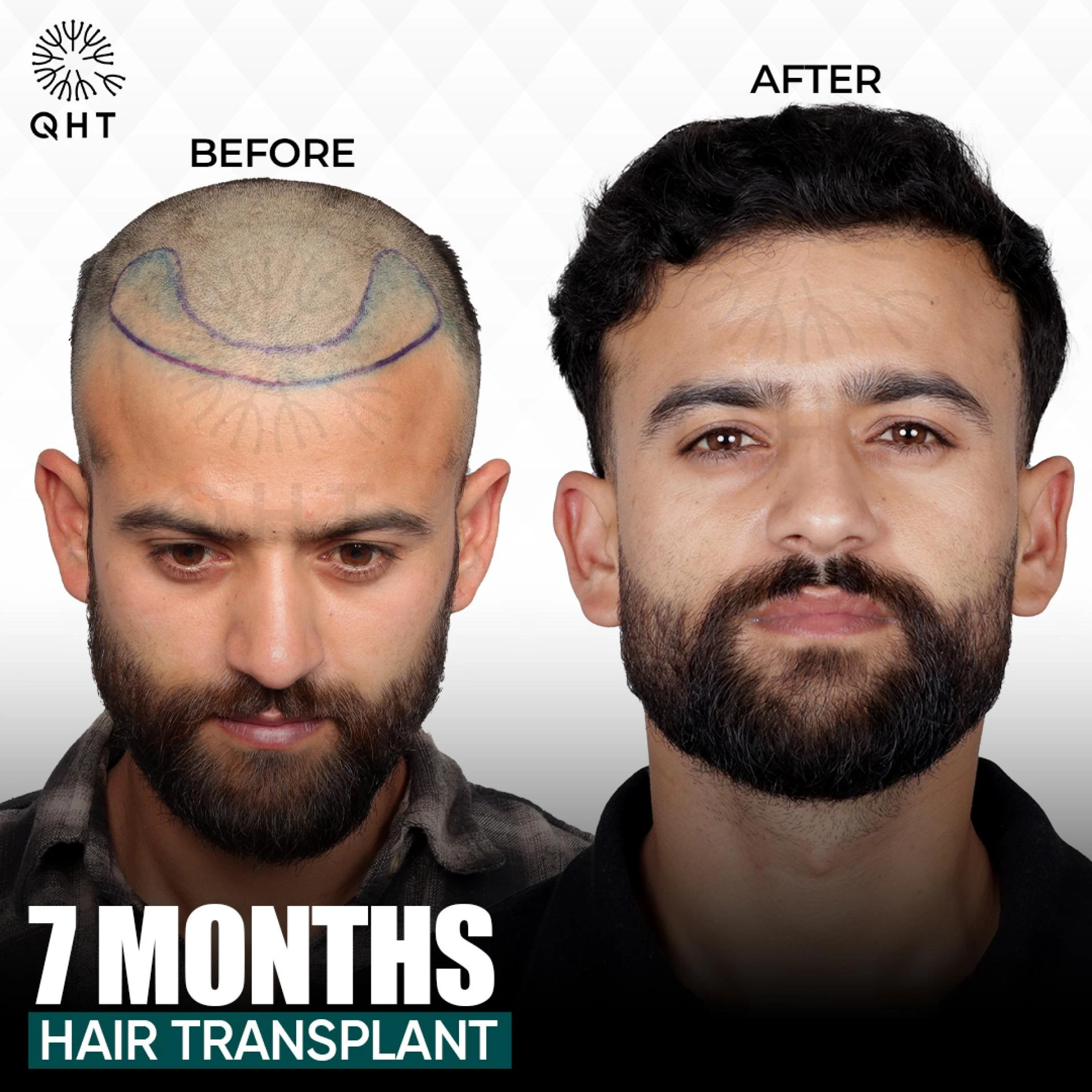 Best FUE Hair Transplant In India |QHT Clinic|
