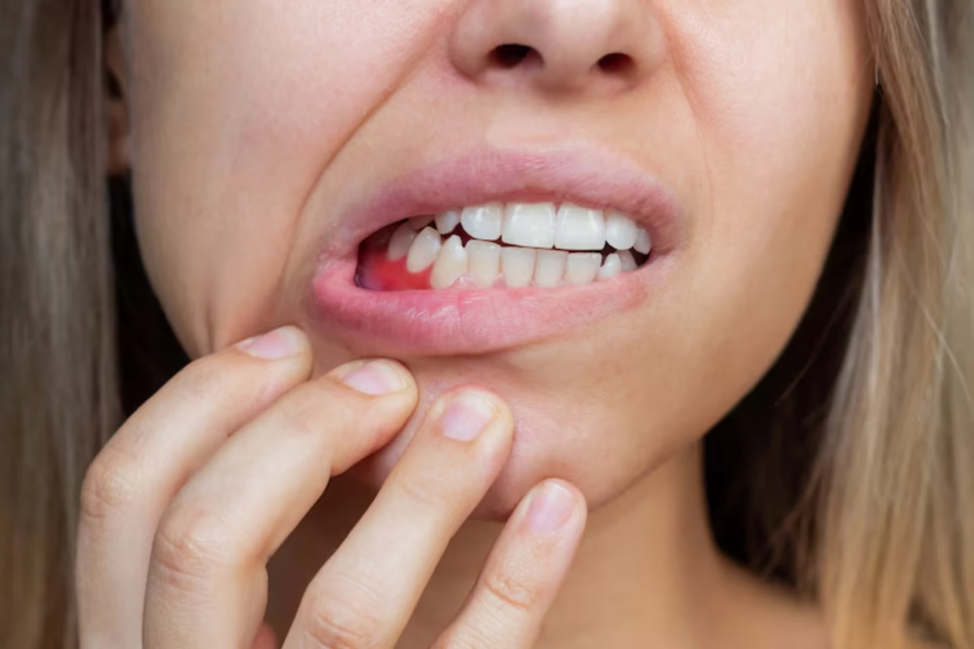 How to Get Rid of a Mouth Ulcer: Tips for Fast Relief