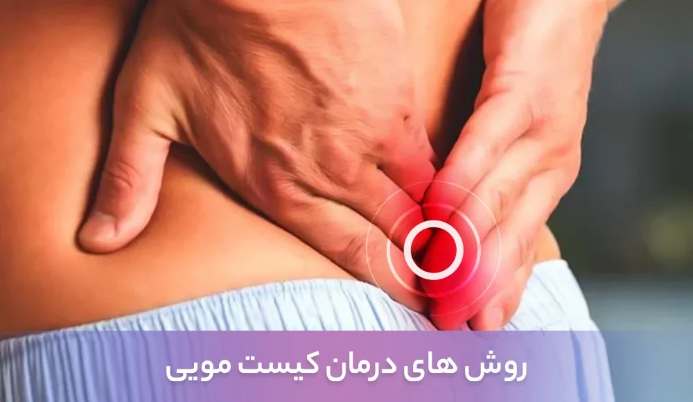 Pilonidal Cyst Treatment