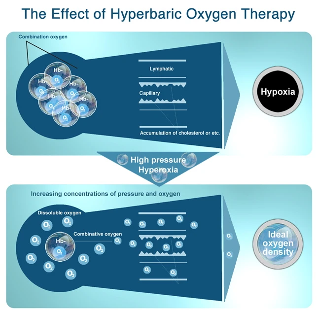 Hyperbaric Oxygen Chamber for Clinical Use