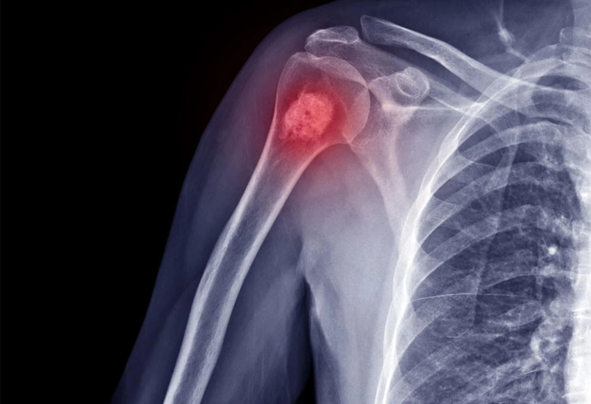  Top 7 Bone Cancer Treatments: What You Need to Know
