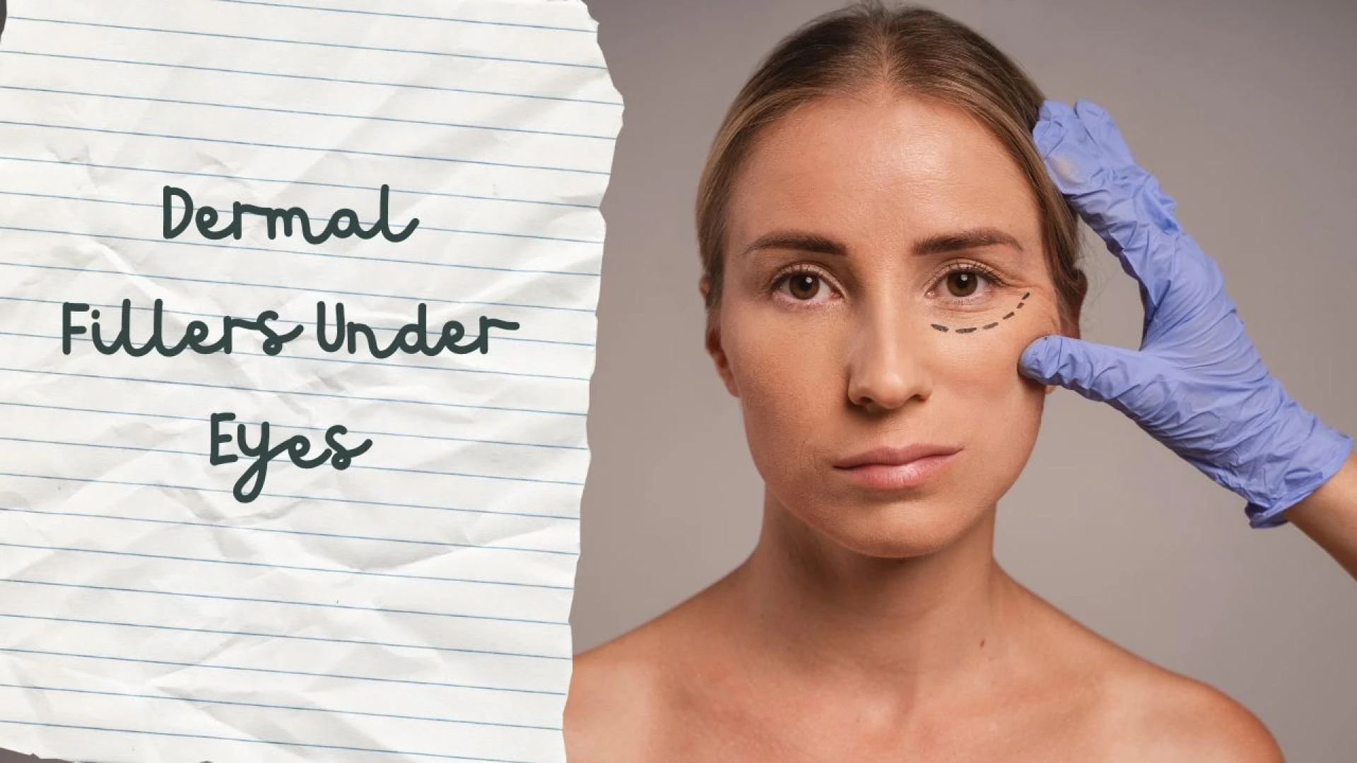 Dermal Fillers Under Eyes