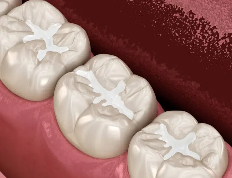 Are You Looking For a Dental Sealants in Newport Beach, CA?