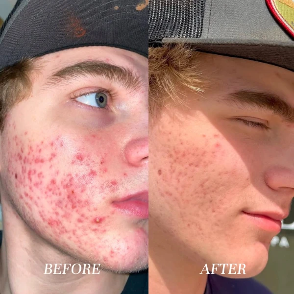 What Actually Works for Acne? Here’s the Scoop.