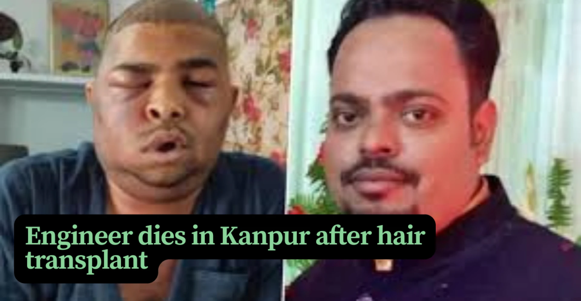 Kanpur Hair Transplant Tragedy Sparks Concern Over Unregulated Clinics