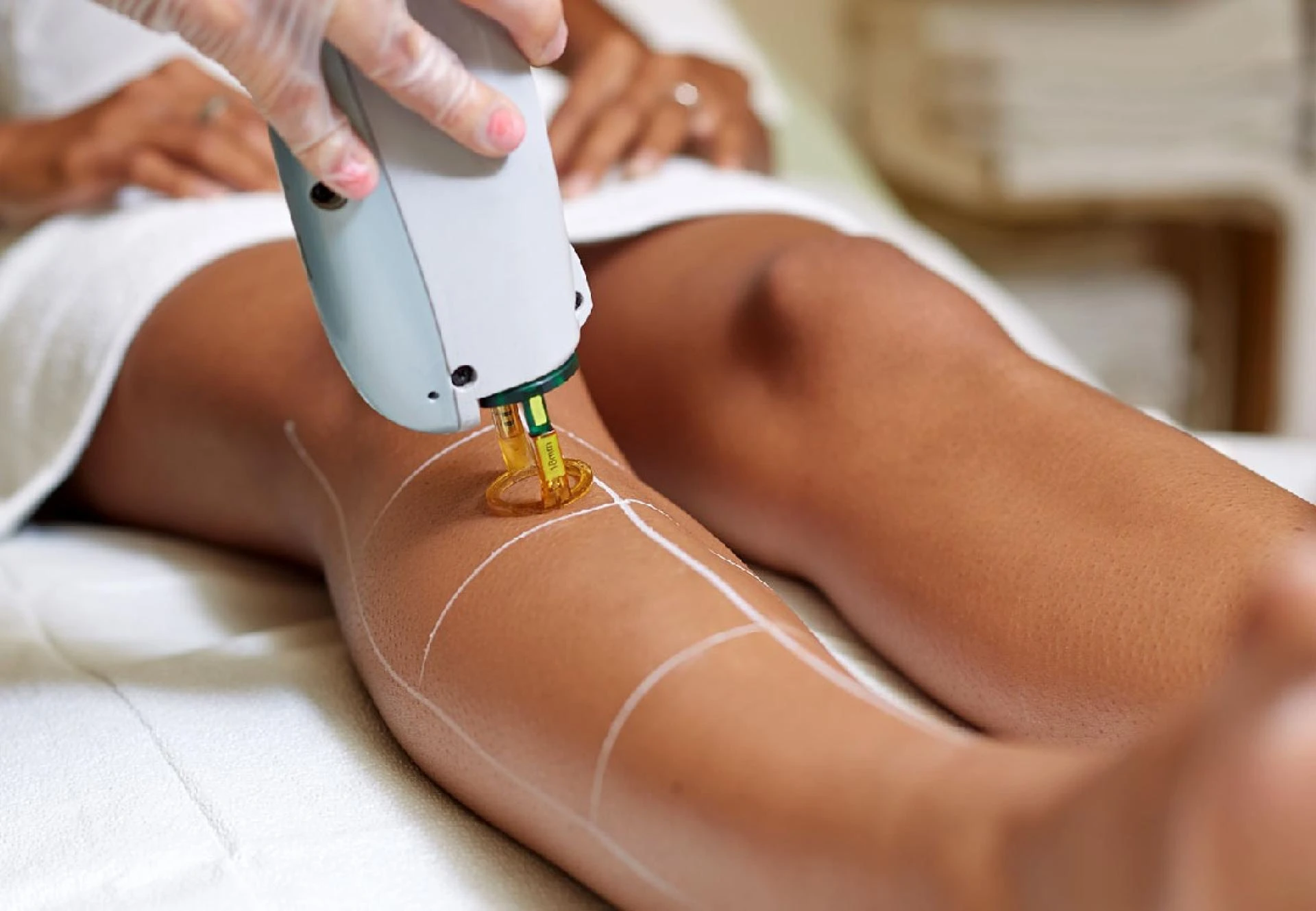 Is Laser Hair Removal Safe for All Skin Types? Insights for Orlando Residents