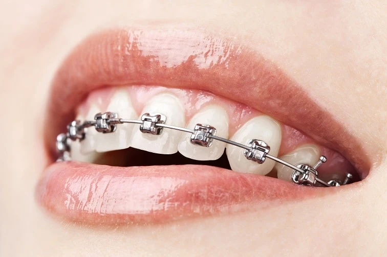 Tollgate Orthodontics: Transforming Smiles Across Warwick and Jamestown, RI