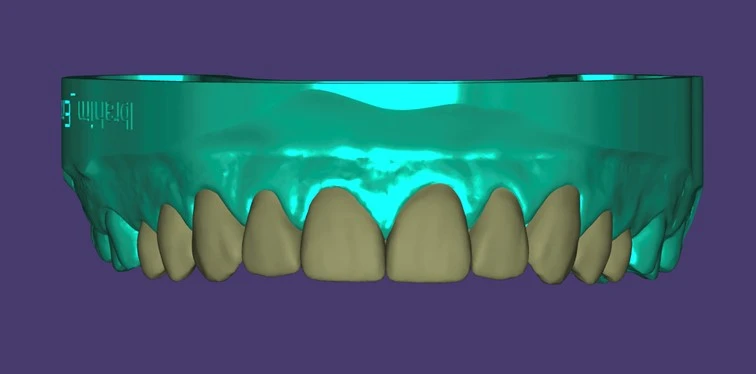 Why Dental CAD CAM Design Is the Game-Changer Every Modern Dentist Needs