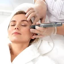 How Microneedling Is Treating Acne Scars in Peshawar Effectively