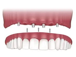 Smile Confidently Again with Trusted Denture Repair in Nampa Idaho