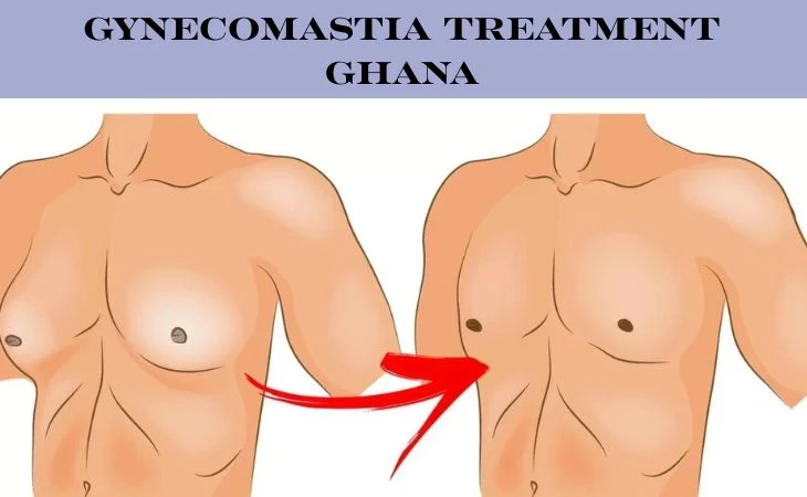 Effective Man Boobs Treatment in Ghana with CCS Ghana