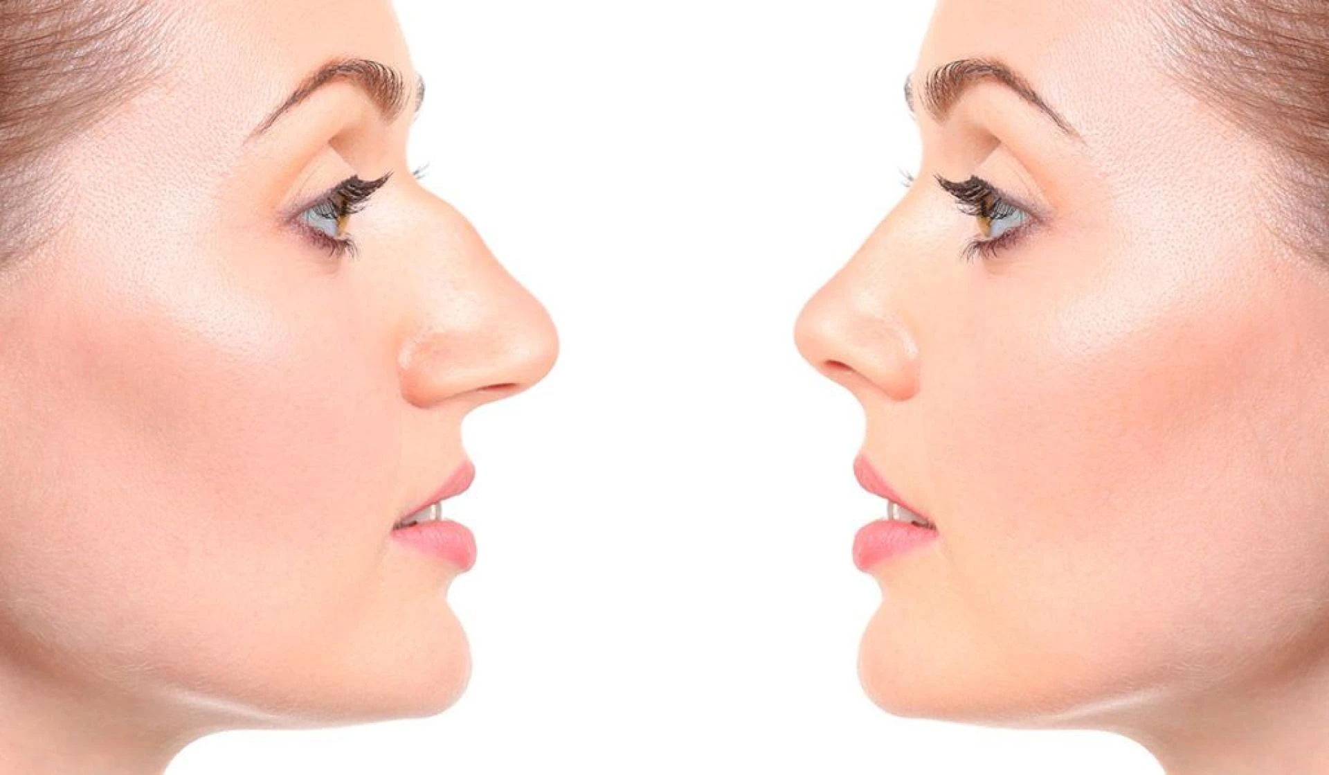 Nose Reshaping London: Transform Your Profile Without Surgery