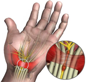 Affordable Carpal Tunnel Syndrome Treatment Lahore – What You Need to Know