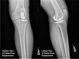Knee Replacement Lahore: Your Guide to Mobility