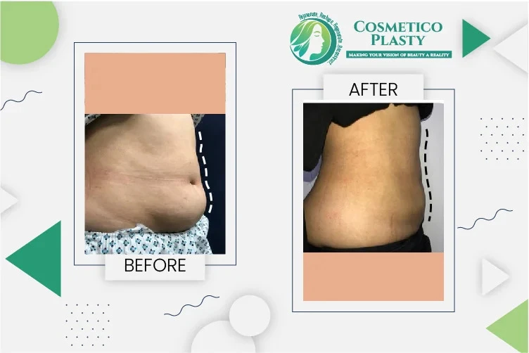 Liposuction in Lahore: What to Expect Before, During, and After
