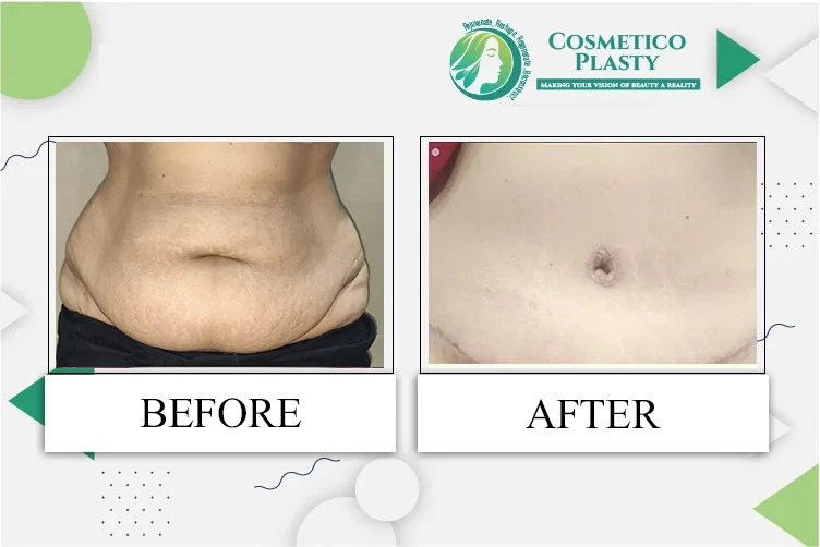 Mini vs. Full Tummy Tuck in Lahore: Which One Is Best for You?