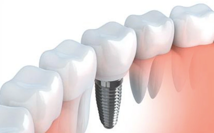 Kemptville dental implants: the lasting remedy to missing teeth