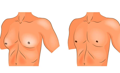 Choosing the Right Clinic for Gynecomastia Surgery in Lahore: 5 Key Factors
