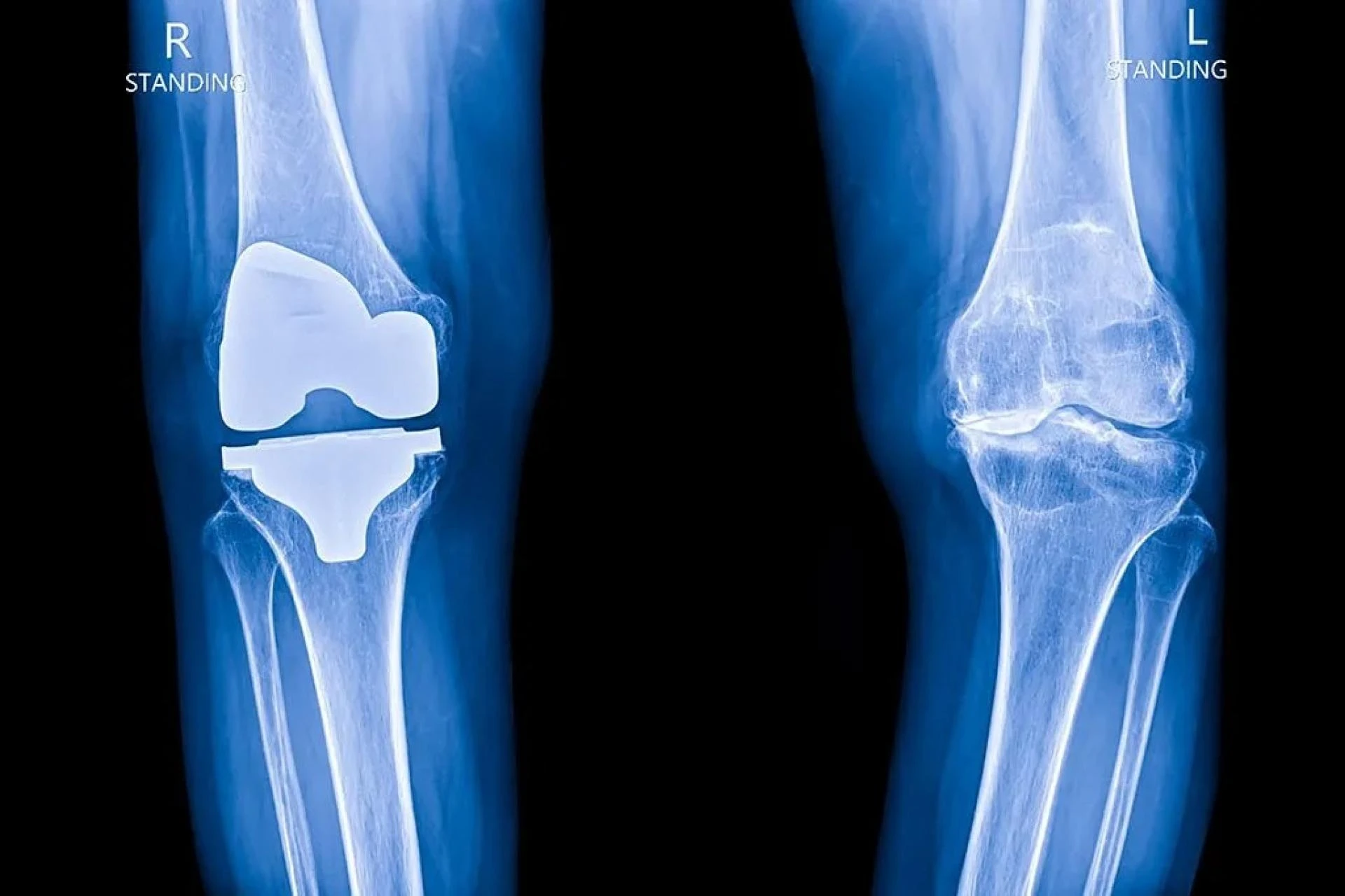 Knee Replacement Cost in Lahore: Everything You Need to Know