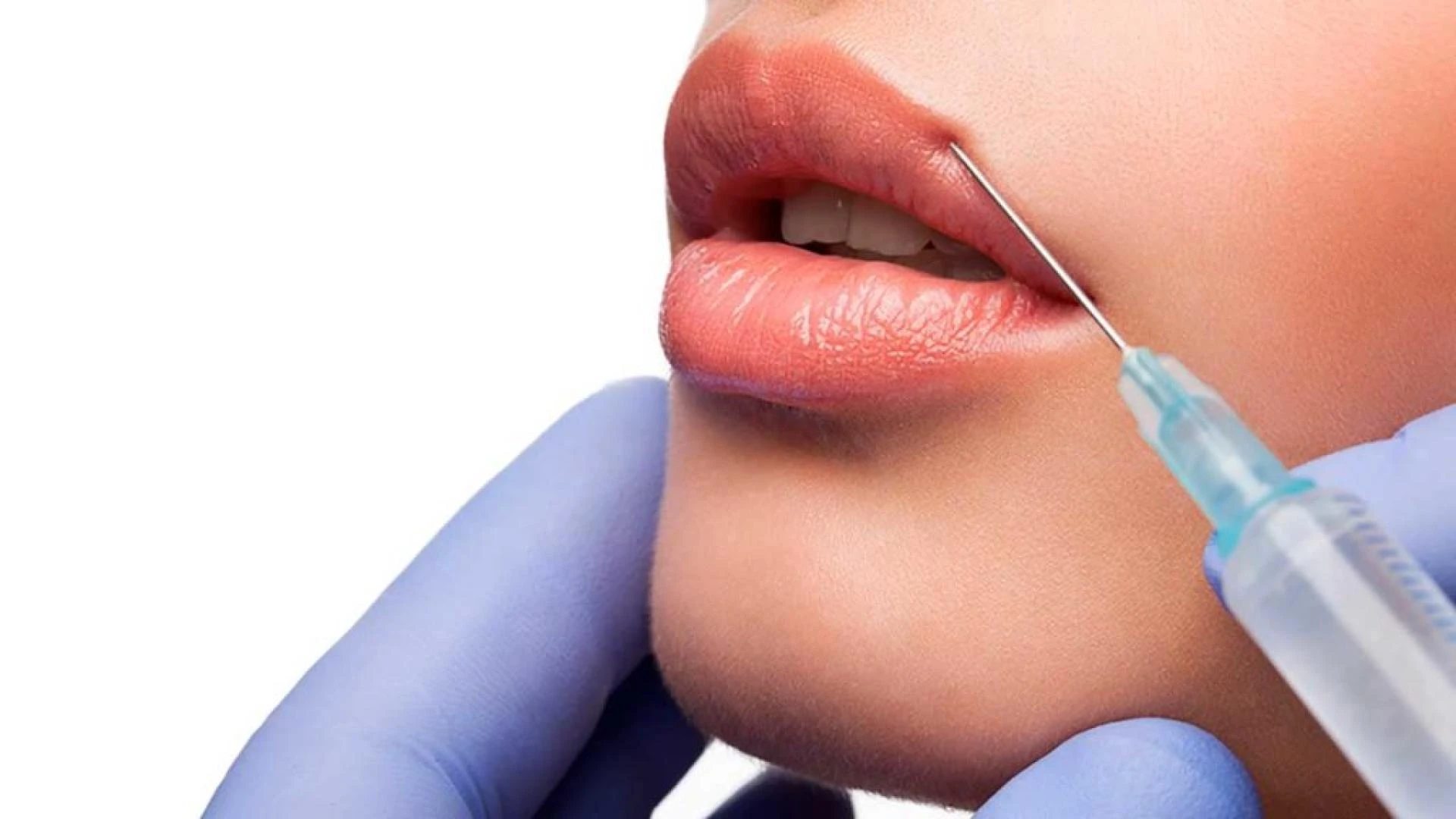 Best Lip Filler Treatments Available in the East Midlands